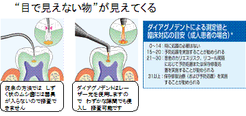 レーザーで虫歯診断・予防に有効ダイアグノデント 福岡市東区　ほほえみ歯科