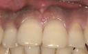 審美歯科　歯肉のホワイトニング　メラニン除去