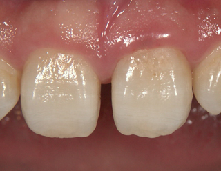 審美的に良くない　歯周病　歯肉の下の歯石　歯石取りの必要あり